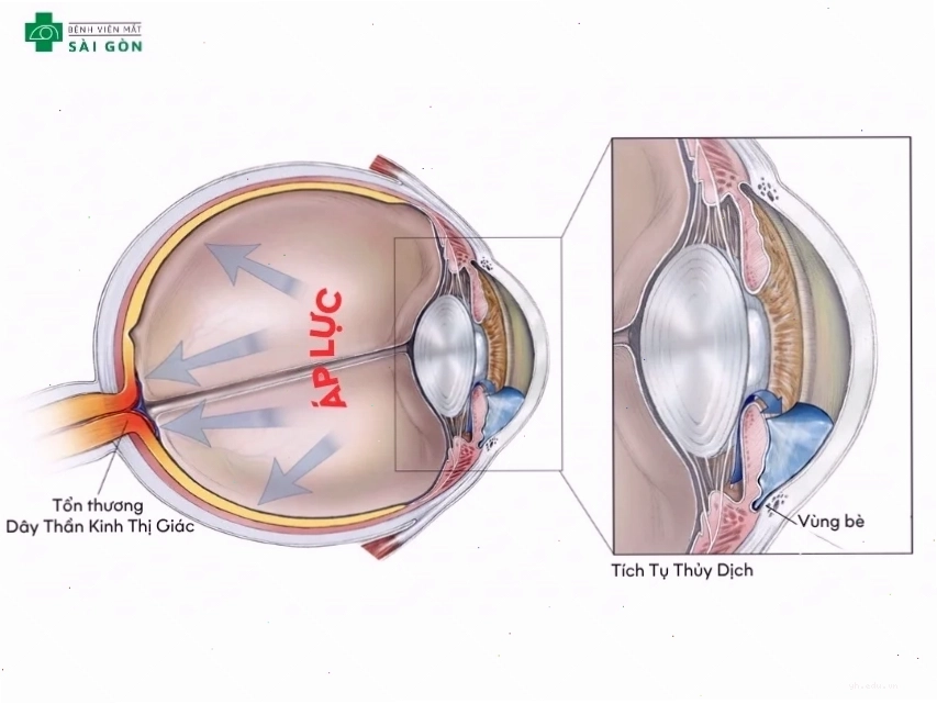 Tích tụ thủy dịch trong mắt gây glaucoma