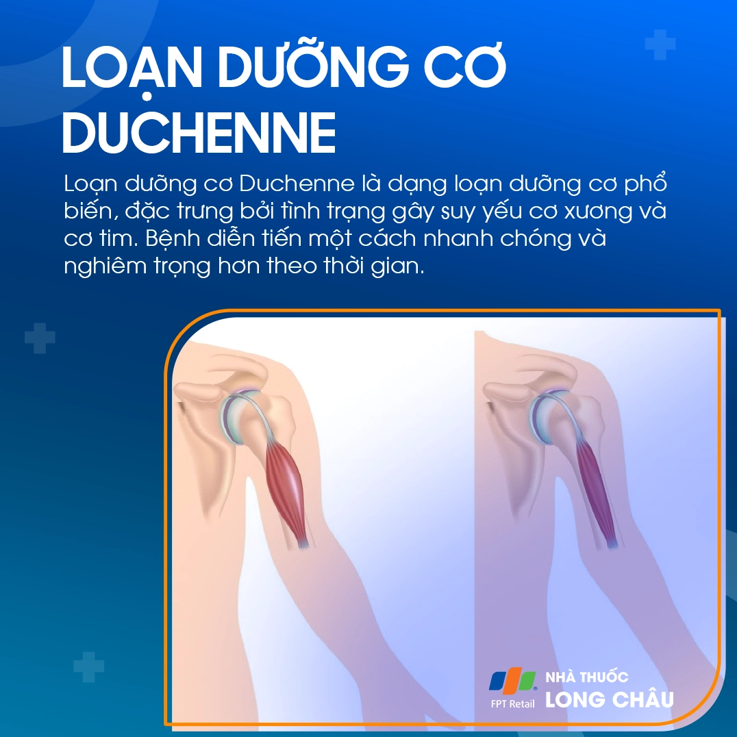 Tìm hiểu chi tiết bệnh duchenne là gì và những thông tin y khoa cần biết