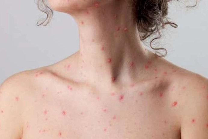 Tìm hiểu chi tiết bệnh thuỷ đậu lây qua đường gì và cách phòng ngừa