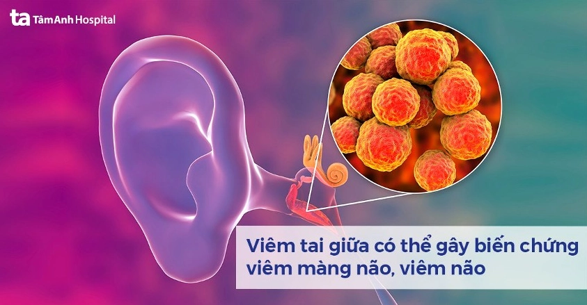 Tìm hiểu chi tiết nguyên nhân gây bệnh viêm tai giữa là gì