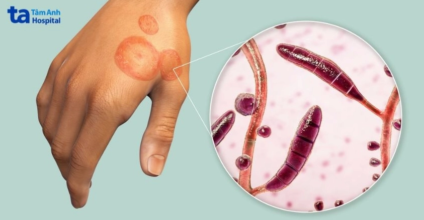 Tìm hiểu chi tiết ringworm là bệnh gì và cách xử lý hiệu quả
