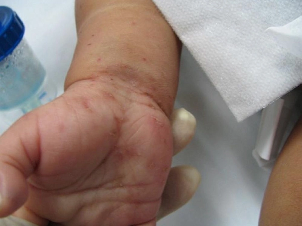 Tìm hiểu chi tiết scabies là bệnh gì và cách phòng ngừa hiệu quả