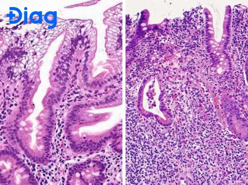 Tìm hiểu rối loạn chuyển hoá lipid gây bệnh gì và cách phòng ngừa hiệu quả
