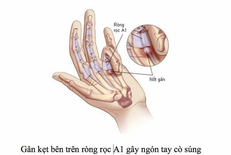 Tìm hiểu tình trạng tay không nắm chặt được là bệnh gì và dấu hiệu nguy hiểm