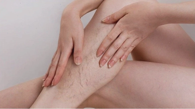 Tĩnh mạch giãn ở giai đoạn đầu khó phát hiện