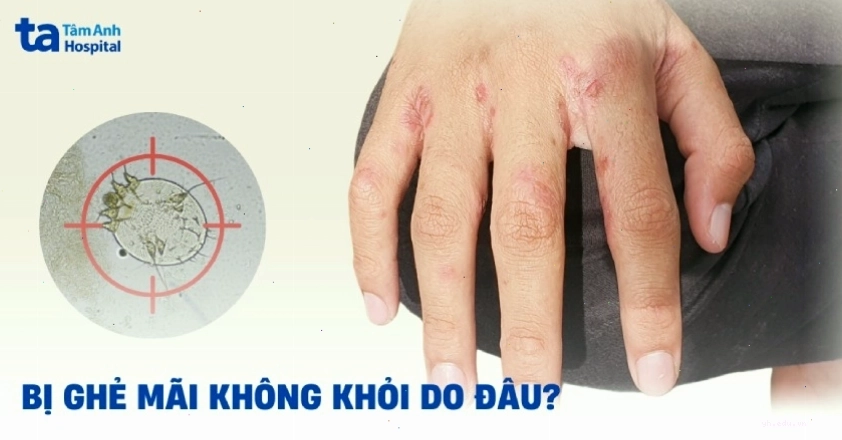 Tình trạng bị ghẻ mãi không khỏi