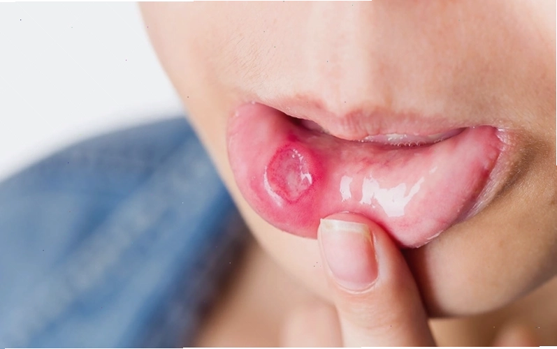 Tình trạng cắn lưỡi khi ngủ 2