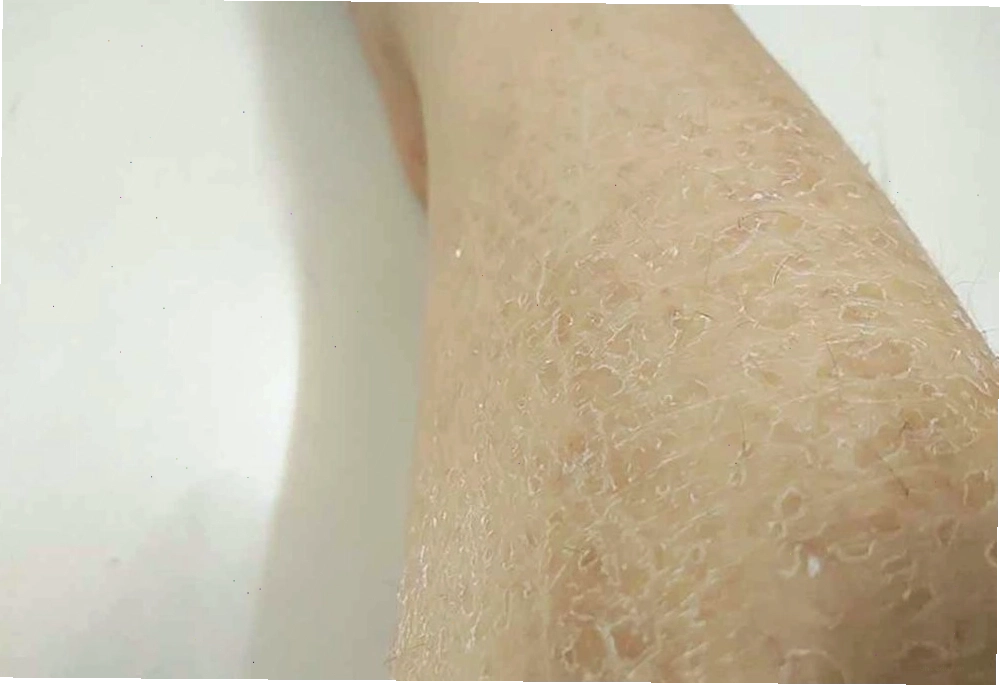 Tình trạng da khô và bong tróc vảy trên bề mặt da