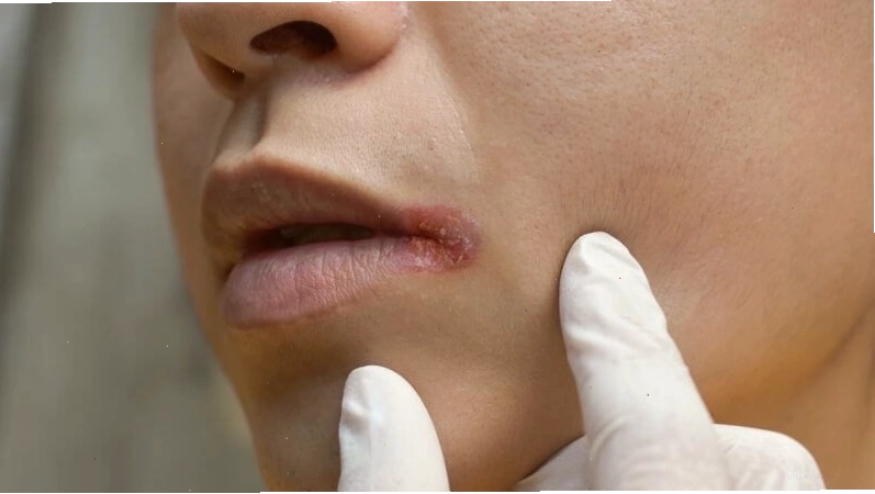 Tình trạng da sưng đỏ và đau rát tại vùng khóe miệng