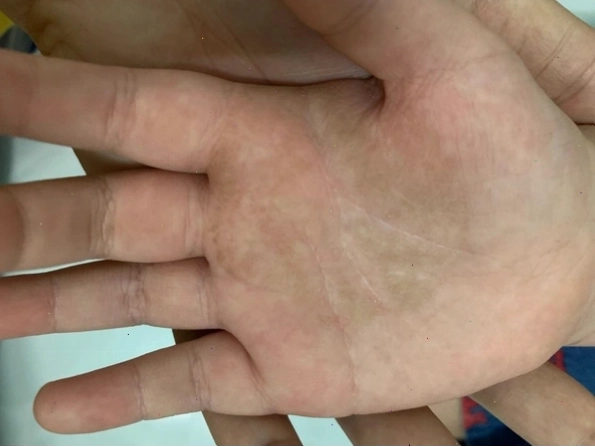 Tình trạng da tay bị nhiễm nấm
