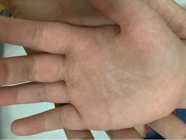 Tình trạng da tay bị nhiễm nấm