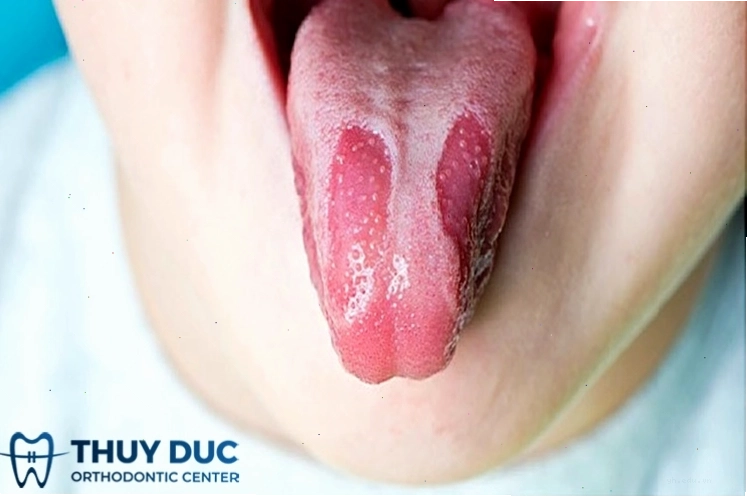Tình trạng lưỡi bản đồ cần phân biệt với lưỡi lông đen