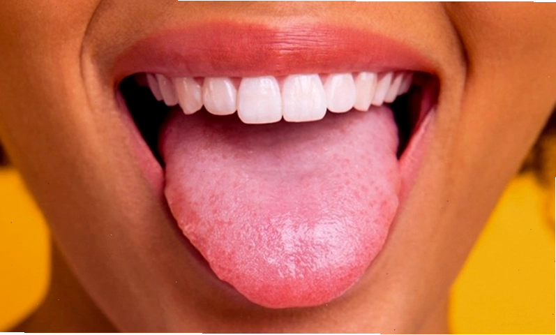 Tình trạng lưỡi trắng kèm mùi hôi