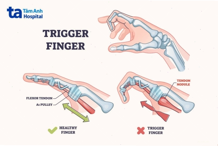 Tình trạng ngón tay bị hạn chế cử động do bệnh lý