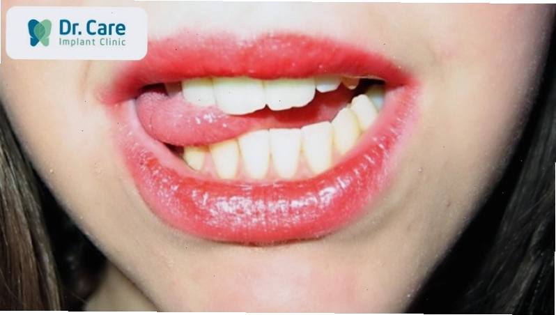 Tình trạng răng cắn lưỡi là gì