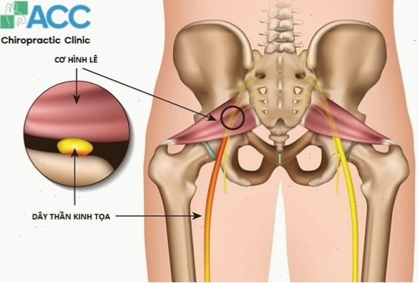 Tình trạng tê chân phát sinh do đâu