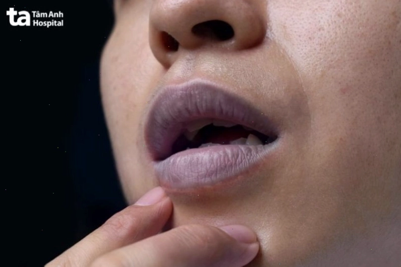 Tình trạng thâm môi nặng