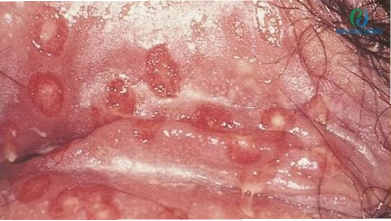 Tinh trùng vón cục màu vàng có thể là dấu hiệu của các bệnh lây qua đường tình dục