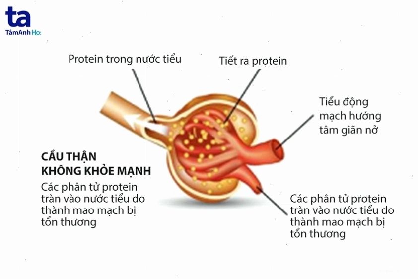 Tổn thương cầu thận do áp lực máu cao