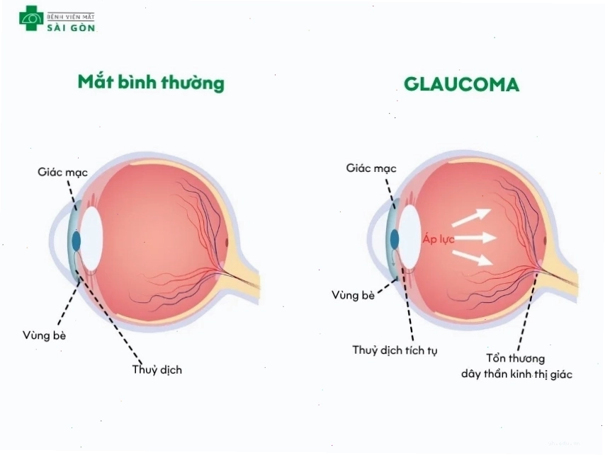 Tổn thương dây thần kinh thị giác do glaucoma