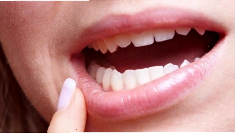 Tổn thương do cắn phải lưỡi