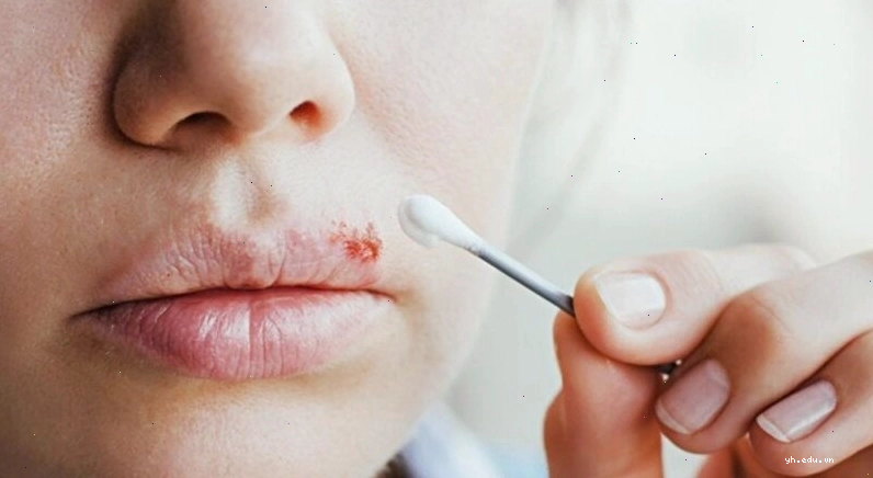 Tổn thương trên da người bị Herpes