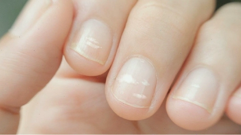Tổng hợp các dấu hiệu cảnh báo bệnh tật qua móng tay