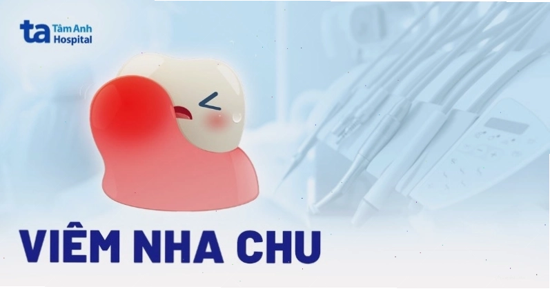 Tổng quan về bệnh viêm nha chu