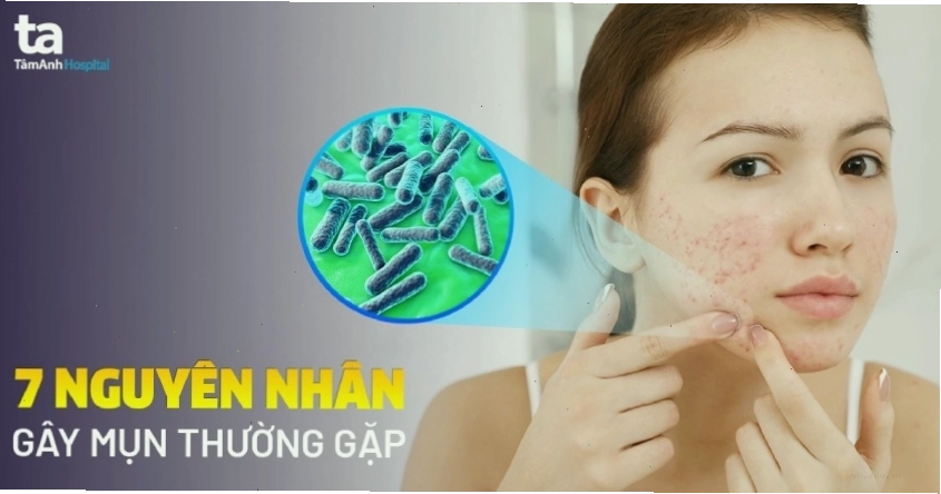 Tổng quan về các loại mụn trứng cá thường gặp trên khuôn mặt