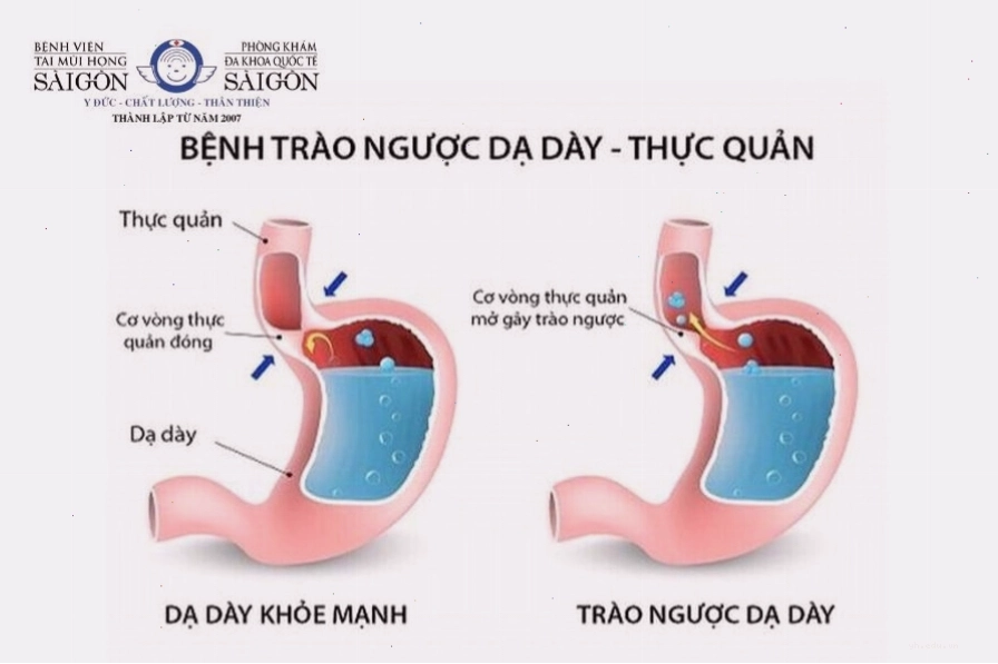 Trào ngược dạ dày thực quản làm khô cổ họng