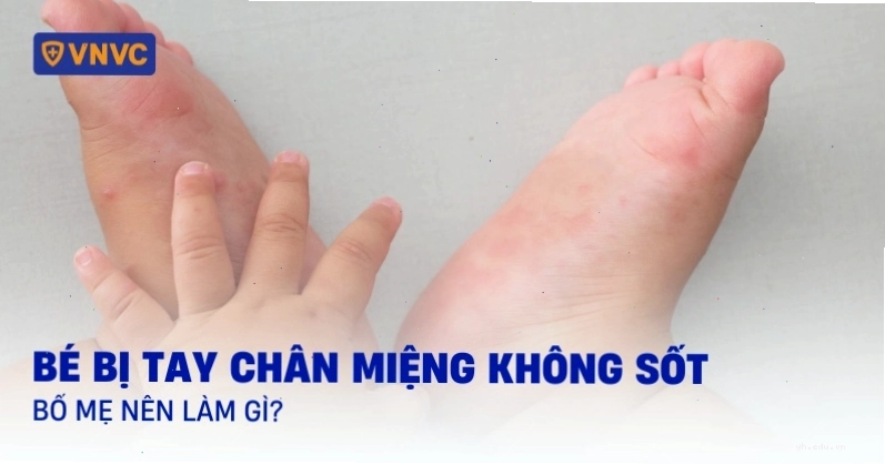 Trẻ bị tay chân miệng nhưng không kèm triệu chứng sốt