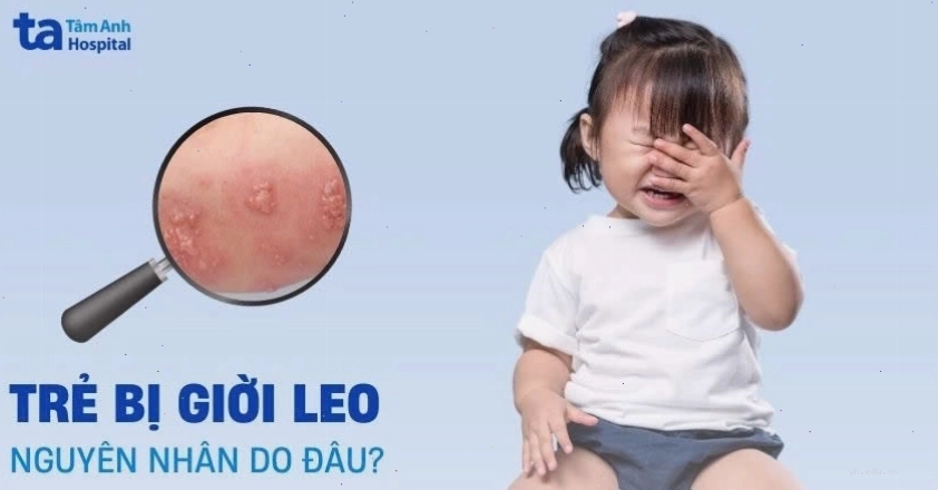 Trẻ em bị giời leo biểu hiện trên da