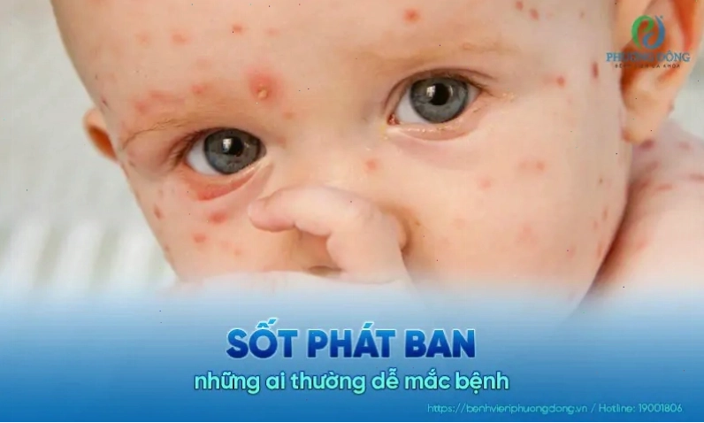 Trẻ em dưới 3 tuổi mắc bệnh sốt phát ban