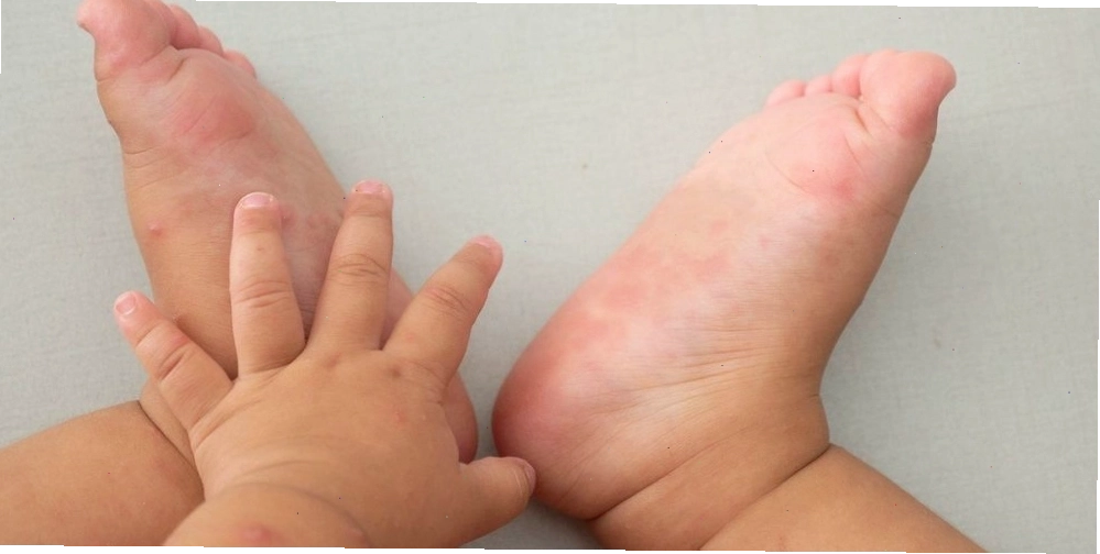 Trẻ em dưới 5 tuổi là đối tượng dễ mắc bệnh tay chân miệng nhất