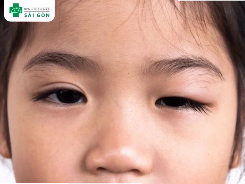 Trẻ em sinh ra đã có tình trạng sụp mí