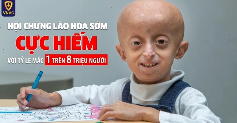 Trẻ em với các biểu hiện đặc trưng của bệnh lão hóa sớm