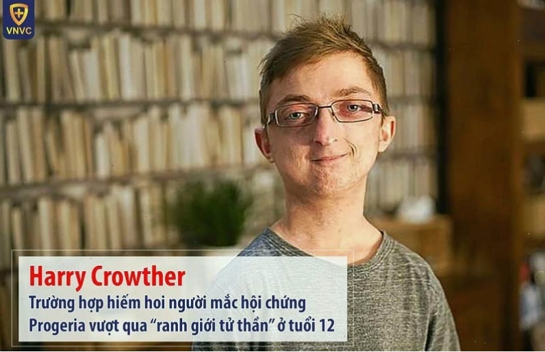 Trẻ mắc hội chứng Progeria với những đặc điểm lão hóa sớm