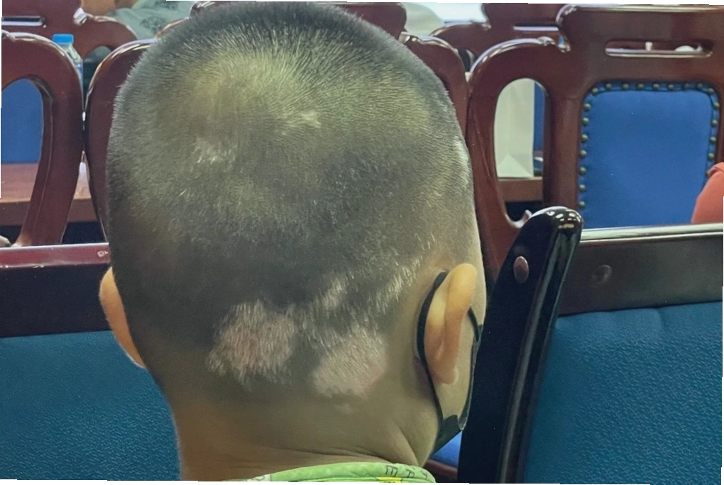 Triệu chứng bệnh bạch biến điển hình