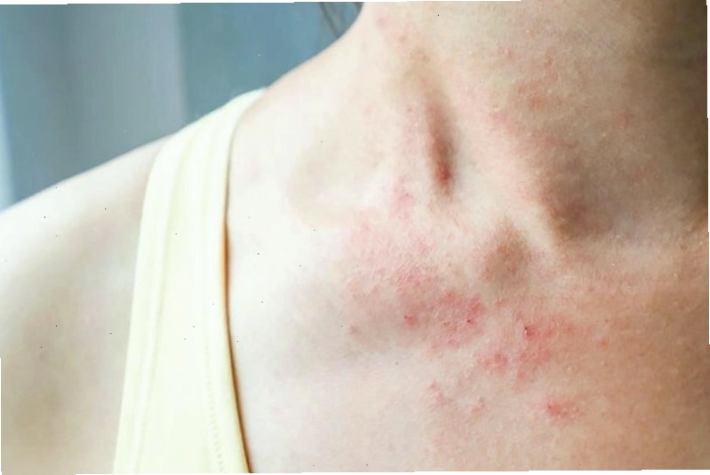 Triệu chứng bệnh chàm bìu