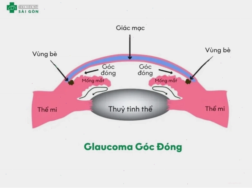 Triệu chứng bệnh glaucoma góc đóng