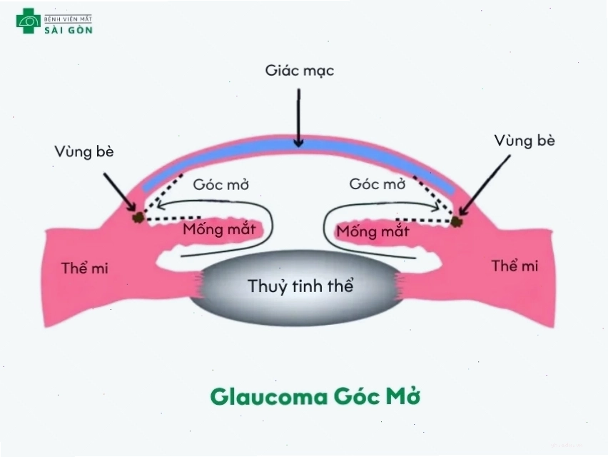 Triệu chứng bệnh glaucoma góc mở
