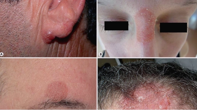 Triệu chứng bệnh lao da ở giai đoạn tiến triển