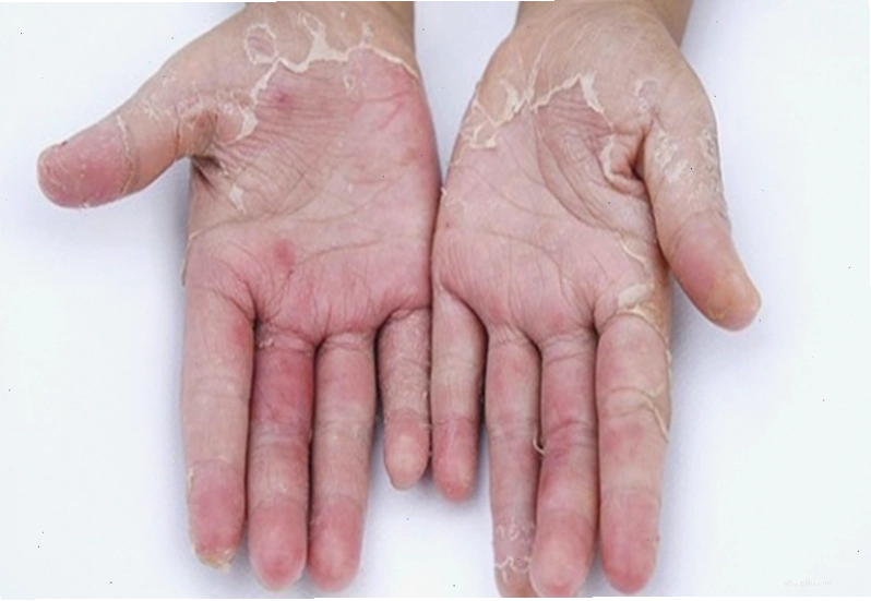 Triệu chứng chàm gây bong da ngứa rát