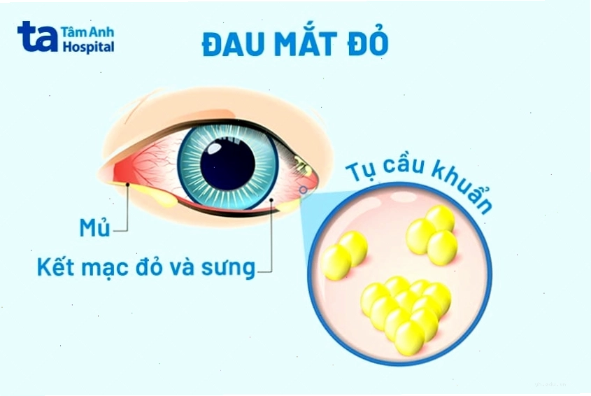 triệu chứng đau mắt đỏ