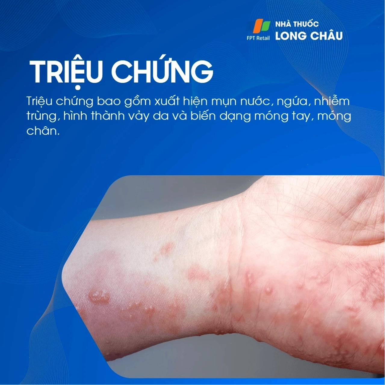Triệu chứng ngứa và đỏ da