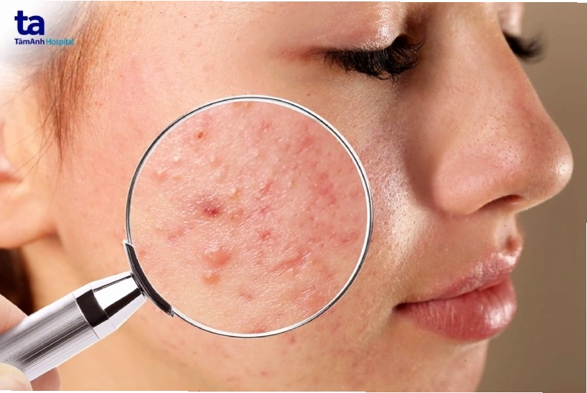 Triệu chứng nhận biết các loại mụn phổ biến trên bề mặt da