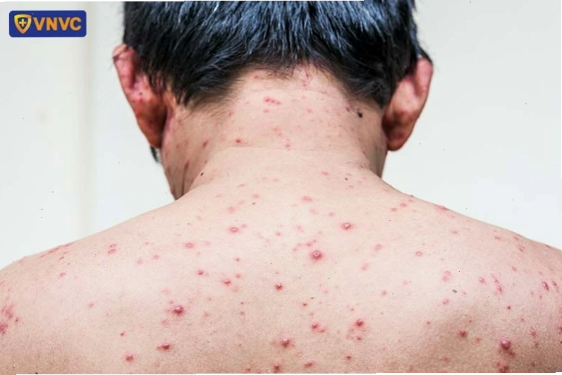Triệu chứng phỏng dạ lan rộng trên bề mặt da
