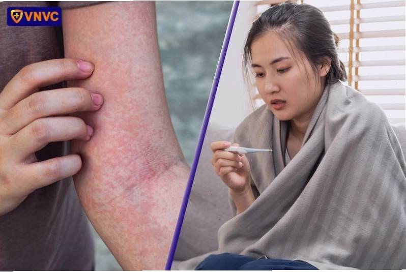 Triệu chứng sốt siêu vi và sốt xuất huyết cần được phân loại