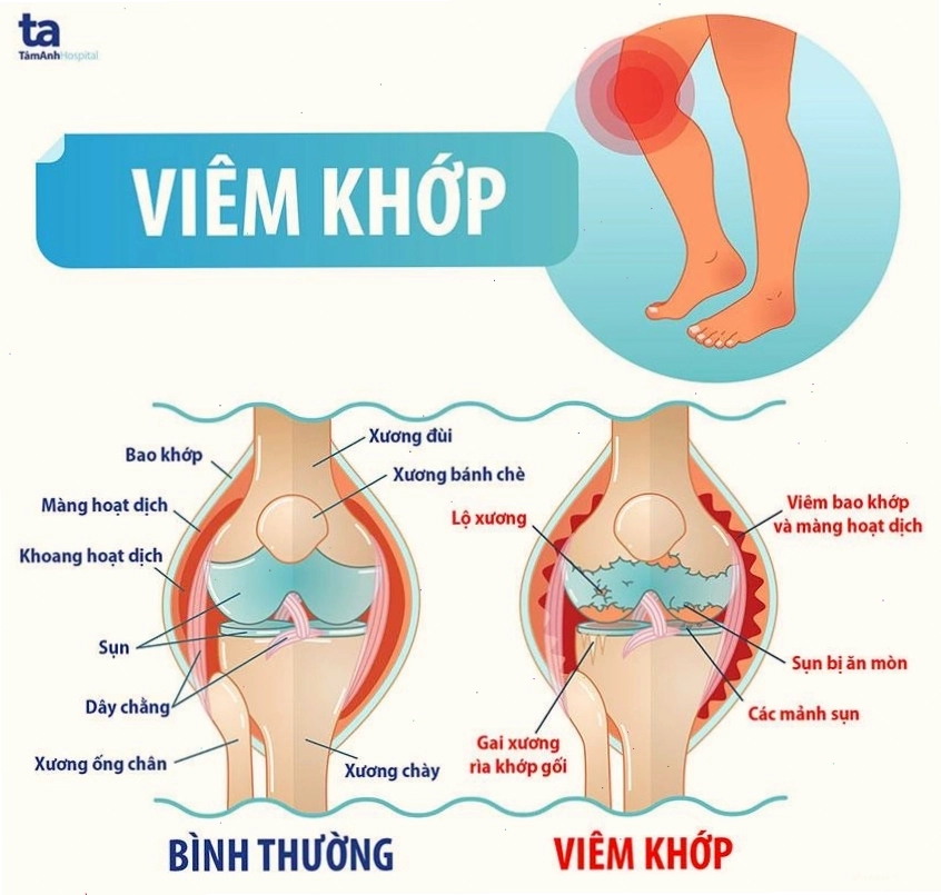 Triệu chứng sưng phù khớp do viêm khớp gây ra