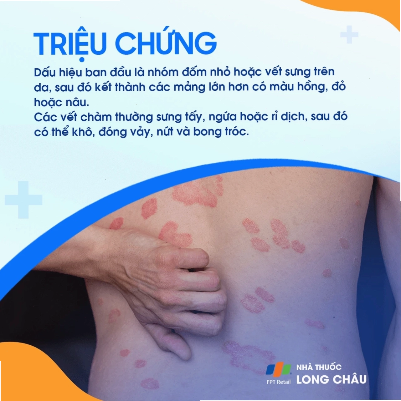 Triệu chứng vết đỏ hình tròn trên da